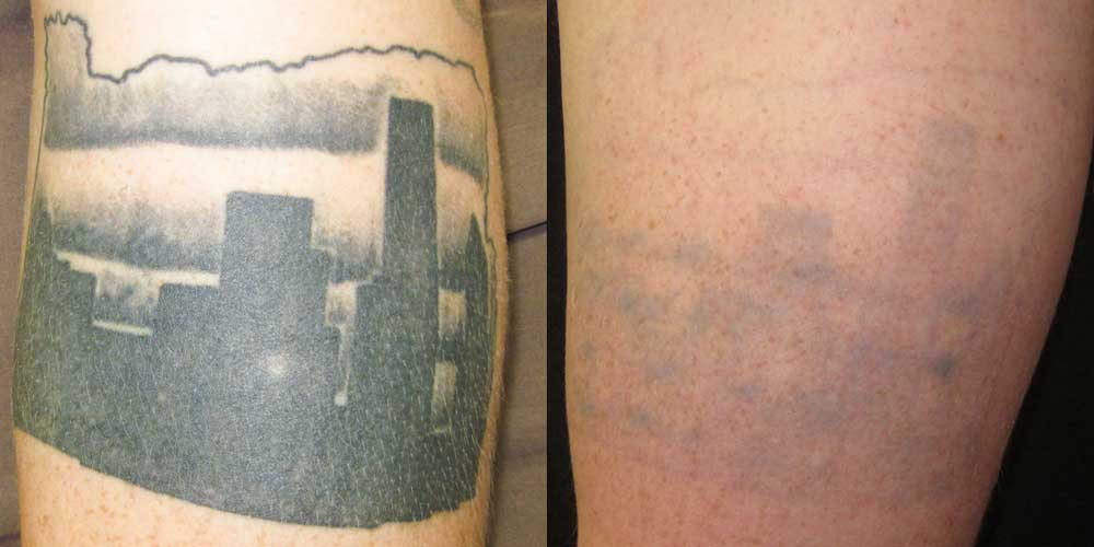 Tattoo Removal Patient #2 Before/After Photo | VIDA Aesthetic Medicine