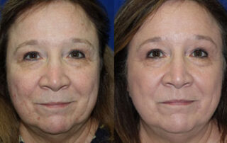 Broadband Light Before/After Photo Patient 1 | VIDA Aesthetic Medicine, Salem, Oregon