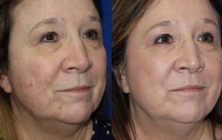 Broadband Light Before/After Photo Patient 1 | VIDA Aesthetic Medicine, Salem, Oregon