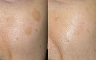 Broadband Light Before/After Photo Patient 2 | VIDA Aesthetic Medicine, Salem, Oregon