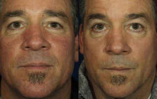 Broadband Light Before/After Photo Patient 3 | VIDA Aesthetic Medicine, Salem, Oregon