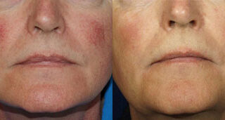 Broadband Light Before/After Photo Patient 4 | VIDA Aesthetic Medicine, Salem, Oregon