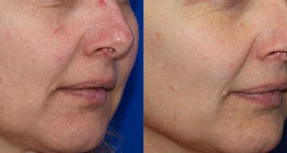 Broadband Light Before/After Photo Patient 5 | VIDA Aesthetic Medicine, Salem, Oregon