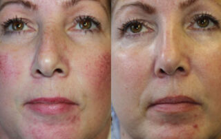Broadband Light Before/After Photo Patient 6 | VIDA Aesthetic Medicine, Salem, Oregon