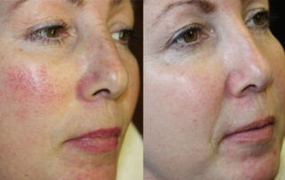 Broadband Light Before/After Photo Patient 6 | VIDA Aesthetic Medicine, Salem, Oregon
