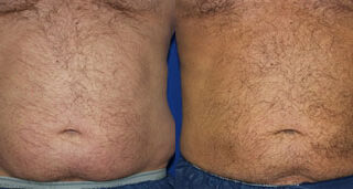 CoolSculpting Before/After Photo Patient 1 | VIDA Aesthetic Medicine, Salem, Oregon