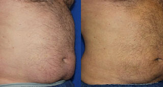 CoolSculpting Before/After Photo Patient 1 | VIDA Aesthetic Medicine, Salem, Oregon