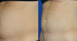 CoolSculpting Before/After Photo Patient 2 | VIDA Aesthetic Medicine, Salem, Oregon