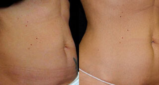 CoolSculpting Before/After Photo Patient 3 | VIDA Aesthetic Medicine, Salem, Oregon