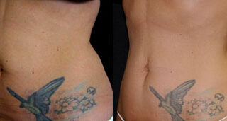 CoolSculpting Before/After Photo Patient 3 | VIDA Aesthetic Medicine, Salem, Oregon