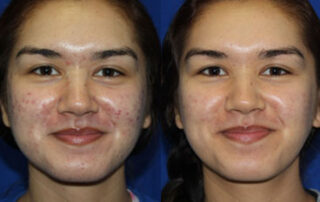 Peels Before/After Photo Patient 1 | VIDA Aesthetic Medicine, Salem, Oregon