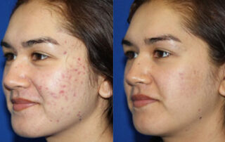 Peels Before/After Photo Patient 1 | VIDA Aesthetic Medicine, Salem, Oregon