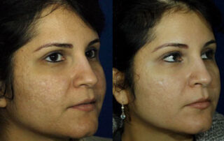 Peels Before/After Photo Patient 2 | VIDA Aesthetic Medicine, Salem, Oregon