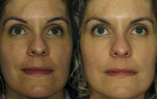 Peels Before/After Photo Patient 3 | VIDA Aesthetic Medicine, Salem, Oregon