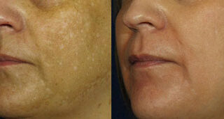 Peels Before/After Photo Patient 4 | VIDA Aesthetic Medicine, Salem, Oregon