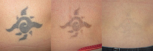 Tattoo Removal Before/After Photo Patient, VIDA Aesthetic Medicine, Salem