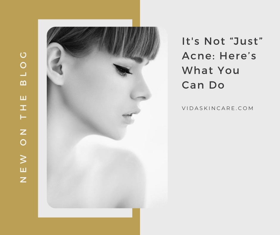 It's Not “Just” Acne: Here’s What You Can Do | VIDA Aesthetic Medicine