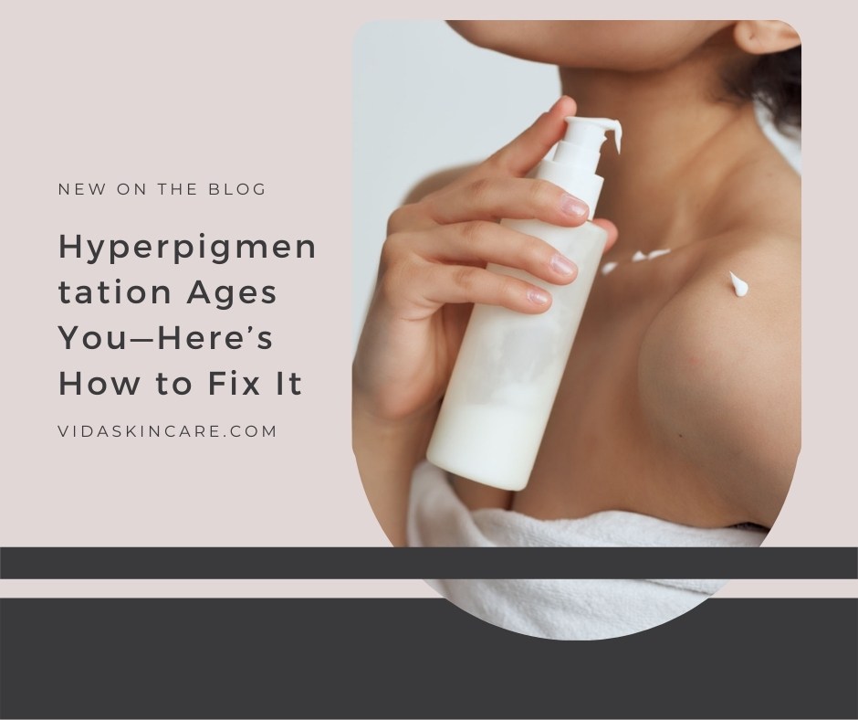 Hyperpigmentation Ages You—Here’s How to Fix It | VIDA Aesthetic