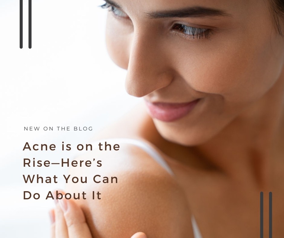 Acne is on the Rise—Here’s What You Can Do About It | VIDA Aesthetic