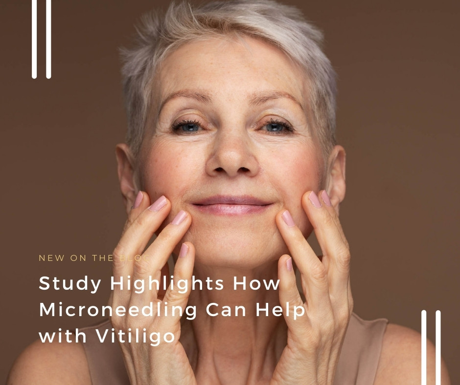 How Microneedling Can Help with Vitiligo | VIDA Aesthetic Medicine