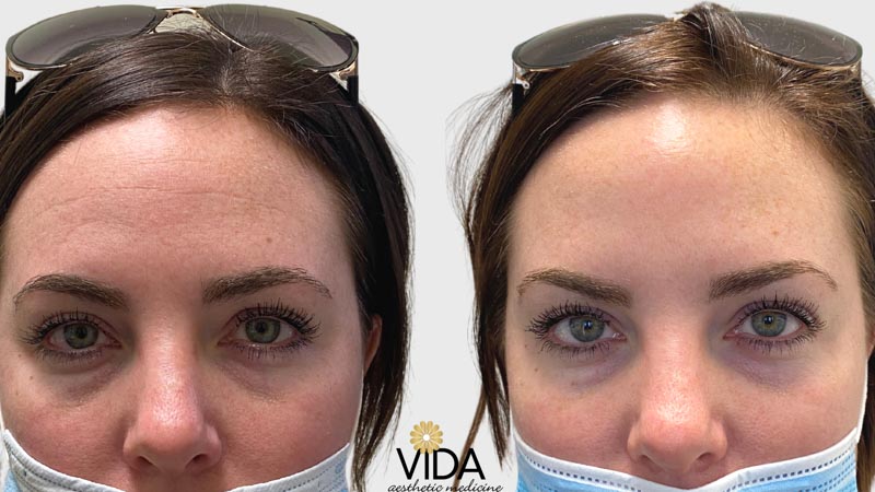 Botox Patient Before/After Photo | VIDA Aesthetic Medicine