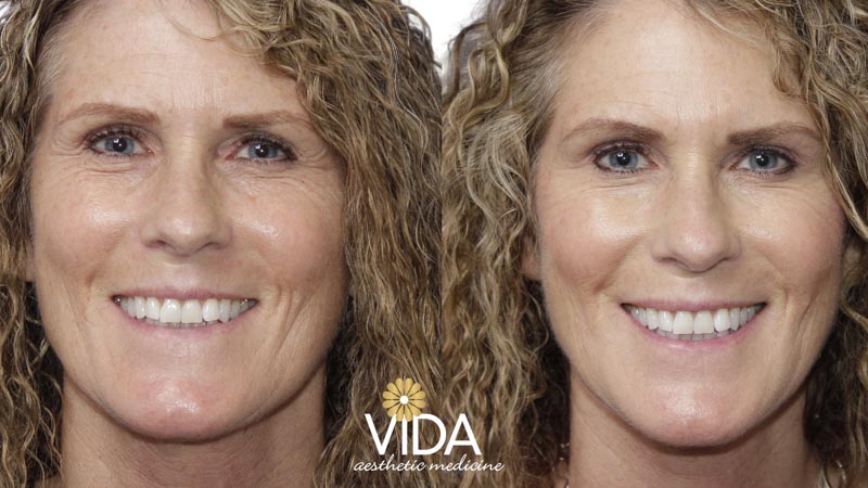 Botox and Fillers Patient Before/After Photo | VIDA Aesthetic Medicine