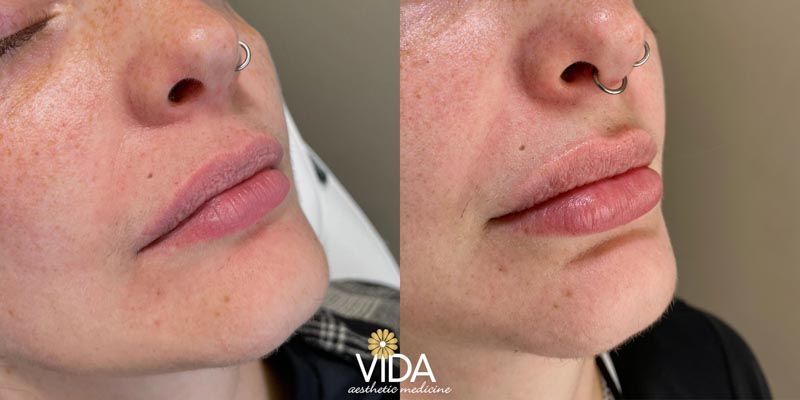 Lip Fillers Patient Before/After Photo | VIDA Aesthetic Medicine