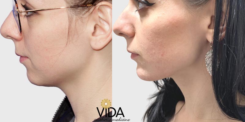 Dermal Fillers Patient Before/After Photo | VIDA Aesthetic Medicine
