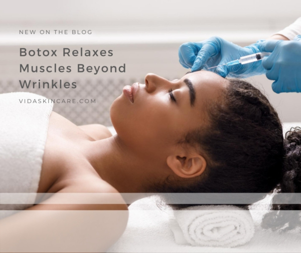 Botox Relaxes Muscles Beyond Wrinkles | VIDA Aesthetic Medicine