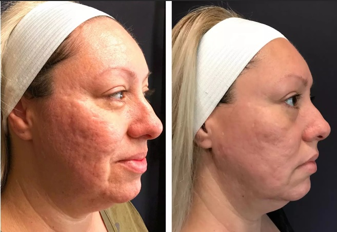 Scarlet acne scars before and after