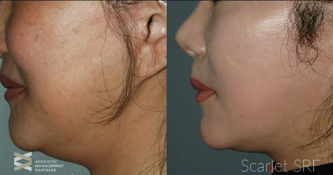 Scarlet RF microneedling before and after