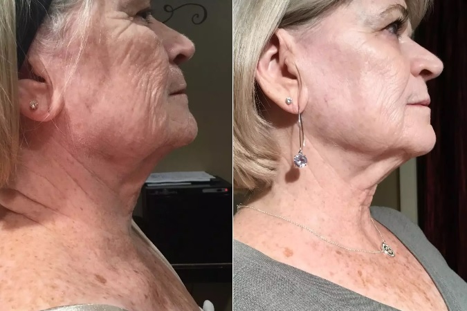 Scarlet RF microneedling face and neck before and after