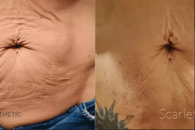 VIDA Scarlet RF Microneedling before and after on the stomach