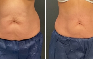 CoolSculpting Patient #4 Before/After Photo | VIDA Aesthetic Medicine