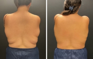 CoolSculpting Patient #3 Before/After Photo | VIDA Aesthetic Medicine