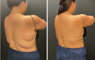 CoolSculpting Patient #3 Before/After Photo | VIDA Aesthetic Medicine