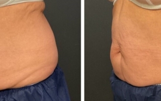 CoolSculpting Patient #4 Before/After Photo | VIDA Aesthetic Medicine