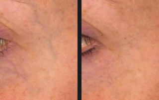 VIDA Aesthetic Medicine | Vbeam Laser treatment before and after 1