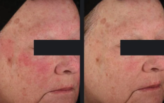 VIDA Aesthetic Medicine | Vbeam Laser treatment before and after 2