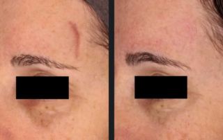 VIDA Aesthetic Medicine | Vbeam Laser treatment before and after 5