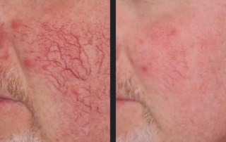 VIDA Aesthetic Medicine | Vbeam Laser treatment before and after 3