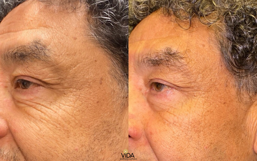 Scarlet RF Microneedling and Botox Before and After (2)| VIDA Aesthetic Medicine Salem, OR and Tigard, OR