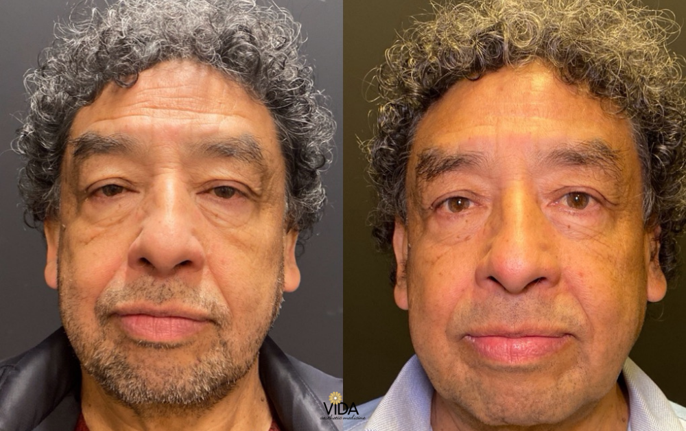 Scarlet RF Microneedling and Botox Before and After | VIDA Aesthetic Medicine Salem, OR and Tigard, OR