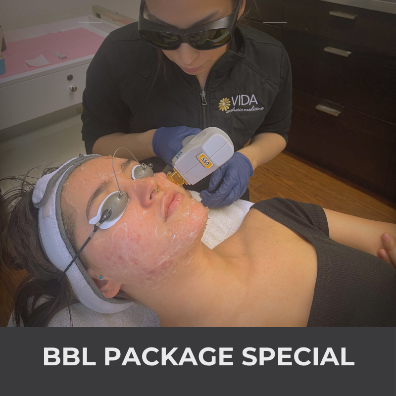 BBL (Broadband Light Therapy) Special| VIDA Aesthetic Medicine Salem, OR and Tigard, OR