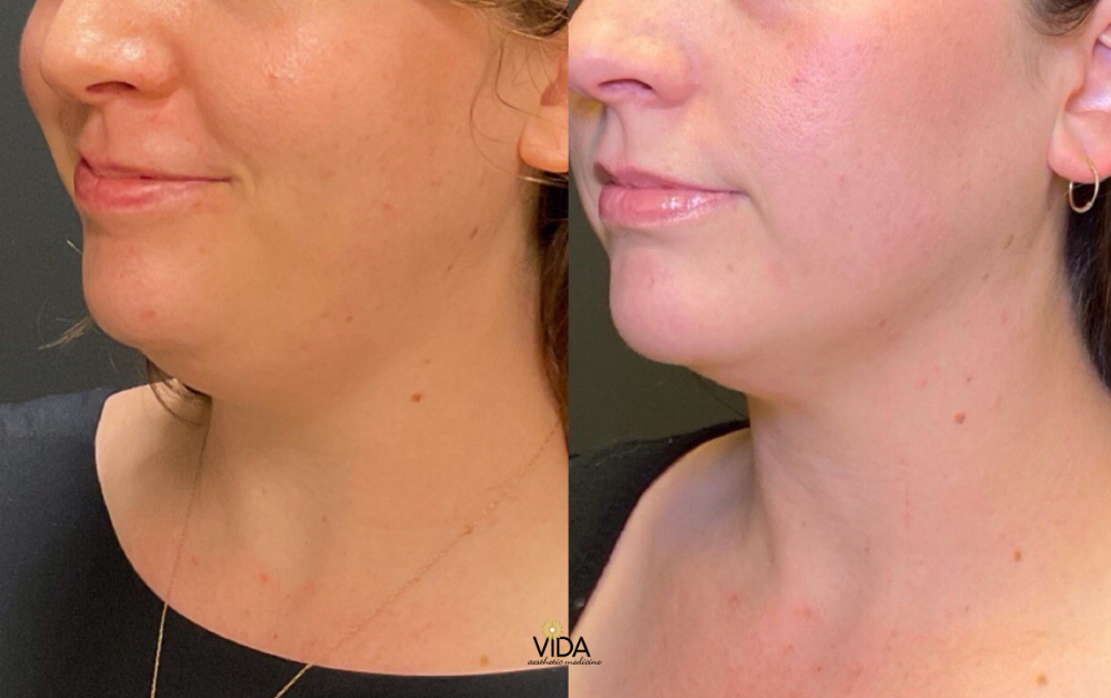 CoolSculpting Elite Chin and Scarlet RF Microneedling Before & After | VIDA Aesthetic Medicine Salem, OR and Tigard, OR