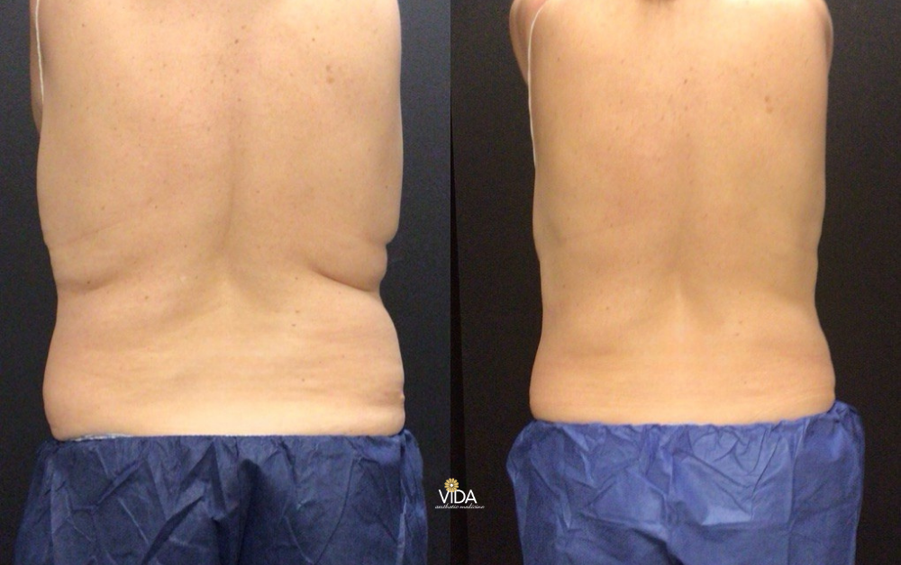 CoolSculpting Elite Body Contouring | VIDA Aesthetic Medicine Salem, OR and Tigard, OR