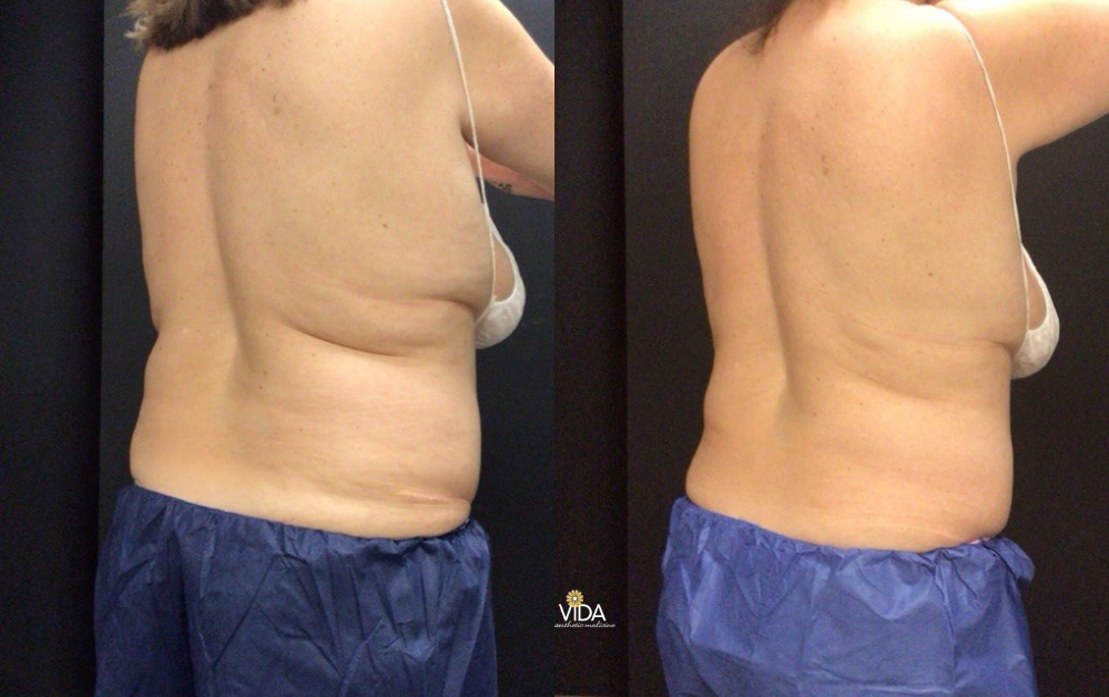 CoolSculpting Elite Body Sculpting | VIDA Aesthetic Medicine Salem, OR and Tigard, OR