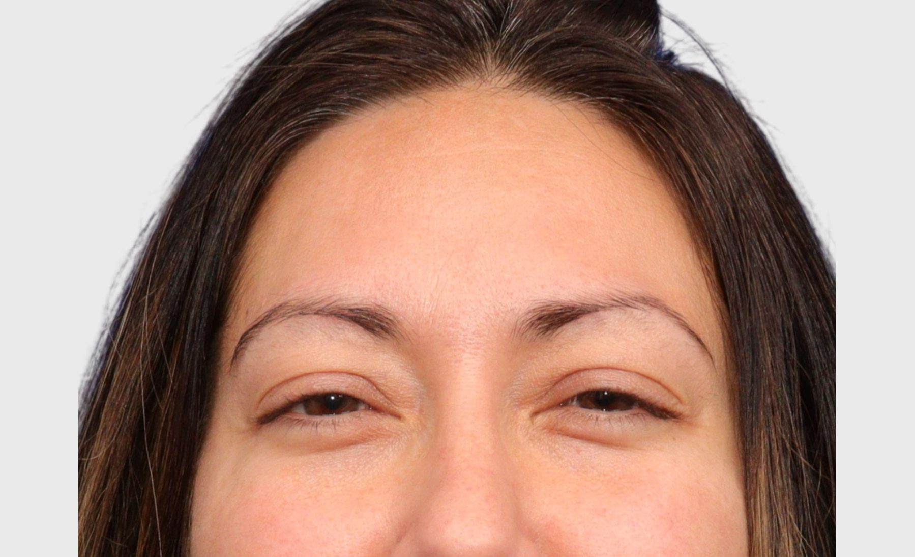 Botox After 2 | VIDA Aesthetic Medicine Salem, OR and Tigard, OR
