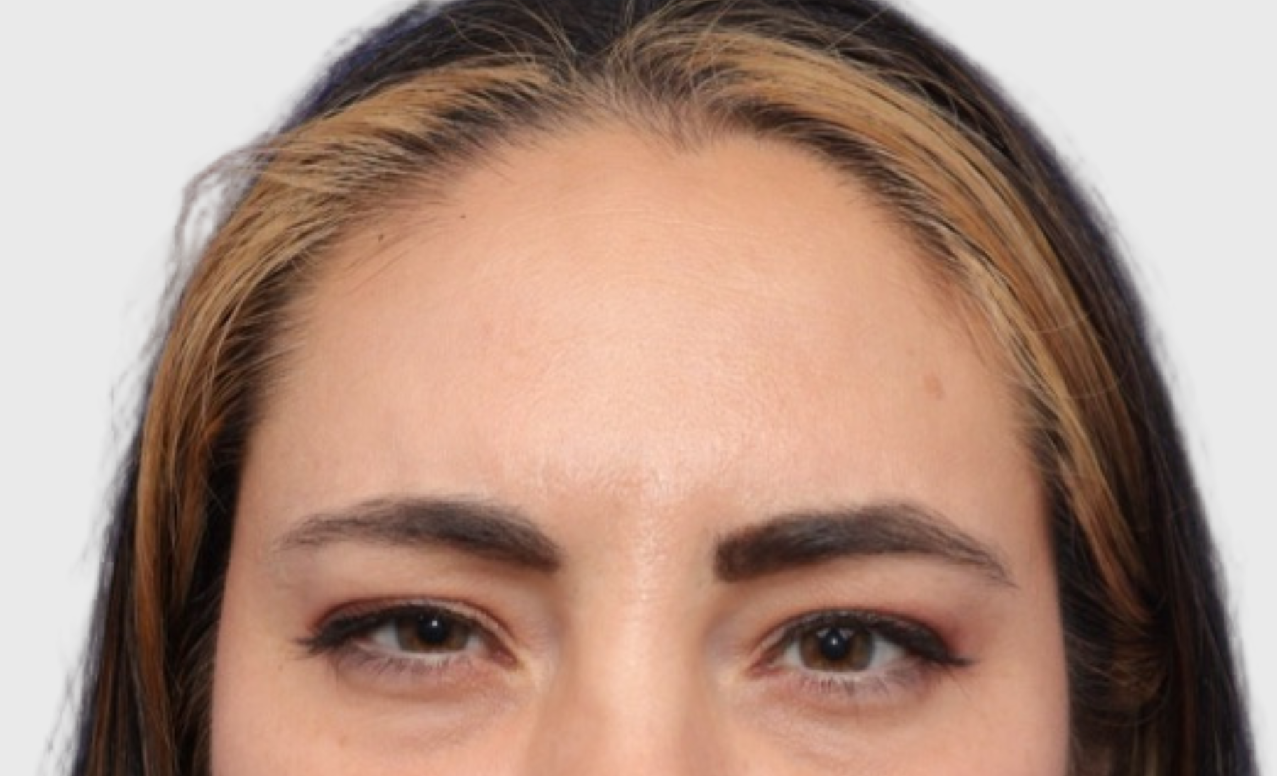 Botox After 3 | VIDA Aesthetic Medicine Salem, OR and Tigard, OR