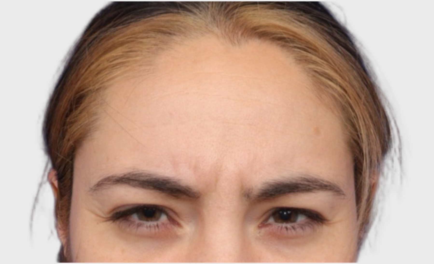 Botox Before 3 | VIDA Aesthetic Medicine Salem, OR and Tigard, OR
